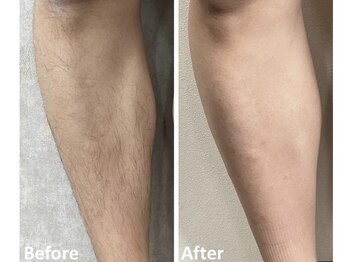 スキル アイラッシュ(SKILL eyelash)/メンズ脱毛☆あし脱毛