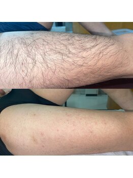 イエナ(IENA)/1回目照射後の効果がこちら!