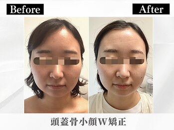 ポーベルポー(Peau Belle poe)/頭蓋骨小顔W矯正＋EGFパック