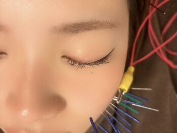 美容鍼・松山市　骨盤神経整体院【小顔矯正・肩こり・鍼治療】