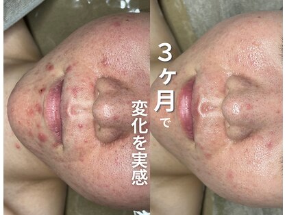 ソアスキン(SOAskin)の写真