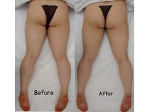 ナラビューティー(NARA BEAUTY)/痩身お尻1回効果