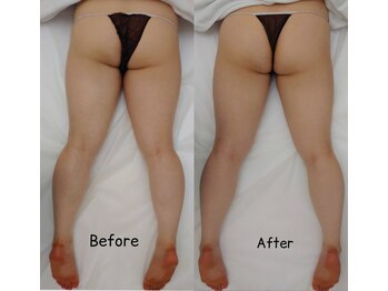 ナラビューティー(NARA BEAUTY)/痩身お尻1回効果