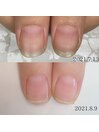 コンプレックス爪/悩み爪