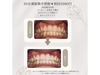 プラスビーセルフ(+b self)/30分連続照射＊ホワイトニング