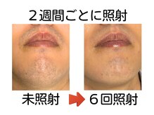 エビアス 旭川豊岡(evias)/メンズ店　大人気！ヒゲ脱毛♪