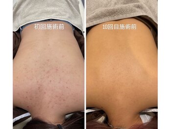 ヒジ(Life Salon)/背中ハーブピーリング