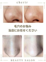 シェリール(cherir) 毛穴悩み 改善