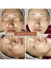 ネリネ(Nerine)/光フェイシャル