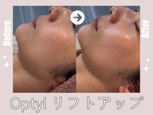 芯美 恵比寿店(shinbi)の雰囲気（韓国最新LDM★Optylで即効リフトアップ！肌の赤みも抑えます）