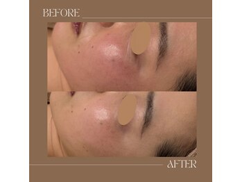 オージン スパ(OJIN SPA)/1回目から変化するピーリング