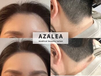 アザレア(Azalea)/フェイシャル脱毛デザイン込