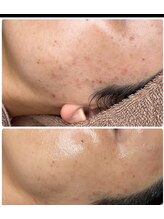 ビオトナス(Facial Esthe)/ララピール施術前後