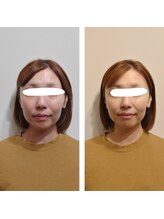 カモン(KAMON)/美顔矯正1回目