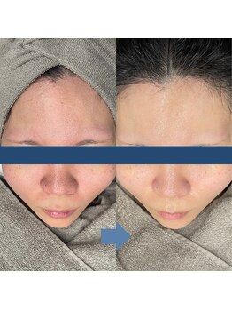 レベンディス(LEVENDIS)/透明感★光フェイシャル BBL