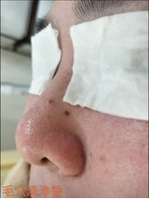 ビューティーサロン 美/毛穴洗浄1回目お手入れ後の写真