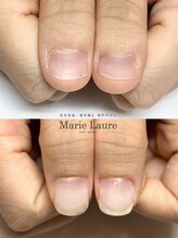 マリーロール 梅田店(Marie Laure)/自爪育成/深爪矯正/ネイルケア