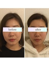 小顔革命 心斎橋/小顔矯正＋超音波リフトアップ