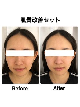 ネオファースト(NeoFirst)/肌質改善セット【20代女性】