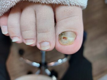 爪切り屋 足楽/肥厚爪施術【before】