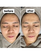 ココン(cocon)/リフトアップコース