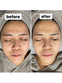 ココン(cocon)/リフトアップコース