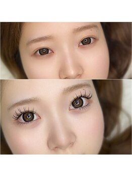 エムエム(mm)/上下BeforeAfter