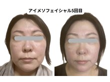 ランネル(Runnel)/アイメソビフォーアフター