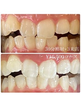 ホワイトニングルーム 横浜店(Whitening Room)/ホワイトニング/横浜