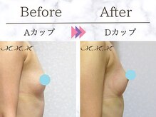 メディカルサロン エム エム エム 銀座プレミアムサロン(M.M.M.)/【バストアップ例】　A→Dカップ