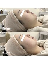 メゾンリュバン 天王寺(Maison Ruban)/脂肪撃退アンプル導入｜小顔