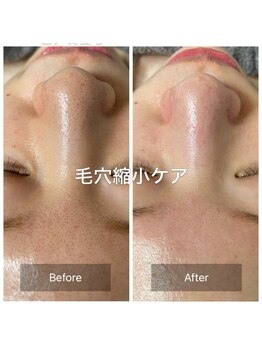 サロン ド オーブ(Salon de Orb)の写真/毛穴洗浄でつるん肌。毛穴の角栓・黒ずみを根本からケアして繰り返さない。自信が持てる素肌へ。
