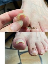 クーラ アンド ベリッシモ(Cura&Bellissimo)/巻き爪補正