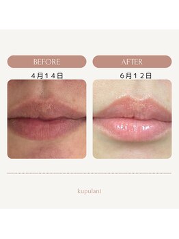 クプラニ 美浜店(kupulani)/メラニンケア(リップ)