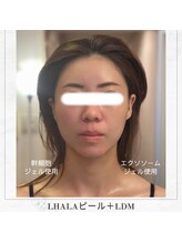 アマテラススキンラウンジ(Amatelas SKIN LOUNGE)/LHALAピール＋LDM