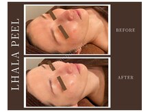 韓国クリニック発！【ララピール】本社認定正規取り扱い店☆