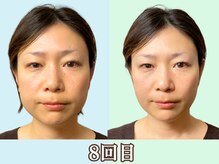 ナチュラルパーフェクトフェイス 新宿/8回目／小顔美人／新宿小顔矯正