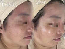 ビューティーサロン プティ(beauty salon petite)/ゆらぎを整える鎮静ケア施術１回