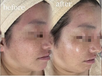 ビューティーサロン プティ(beauty salon petite)/ゆらぎを整える鎮静ケア施術１回