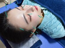 サロン ド ハリッシュ(Salon de HARISH)/美容鍼プレミアムコース★