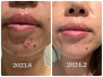 ヒメミ(Himemi)/25年物の頑固な肌荒れ