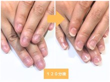 インブロッサム(imblossom)/深爪矯正/自爪風