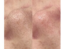 美肌ラボ クリア(clear)の雰囲気（お悩みNo.1毛穴の黒ずみ改善！憧れの毛穴レスを目指しましょう♪）