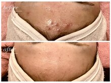 ラヴィン なんばスカイオ店(Lovin)/【ハードハーブピーリング 6回】