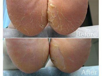 カシェット 広島店(Cachette)/50代女性☆足裏角質ケア90分