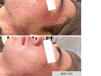 ニキビ研究所 千葉店/もうニキビや跡で悩まない肌へ！