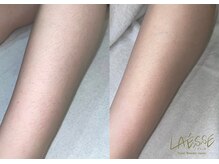 ラエッセ(LAESSE)/〔レディース〕ひざ下脱毛