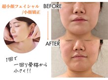 キレイベース 銀座店(KIREI BASE)/超小顔　1回での変化