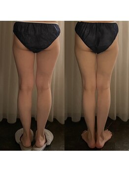 サロン ド プリヴェ(Salon de PRIVE)/隠れO脚改善!脚集中の美脚ケア