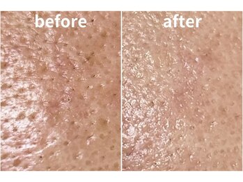 ラティエル(Latiele)/透明肌パックbefore after
